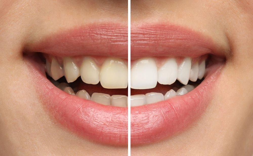 Are There Any Age Restrictions For Teeth Whitening?