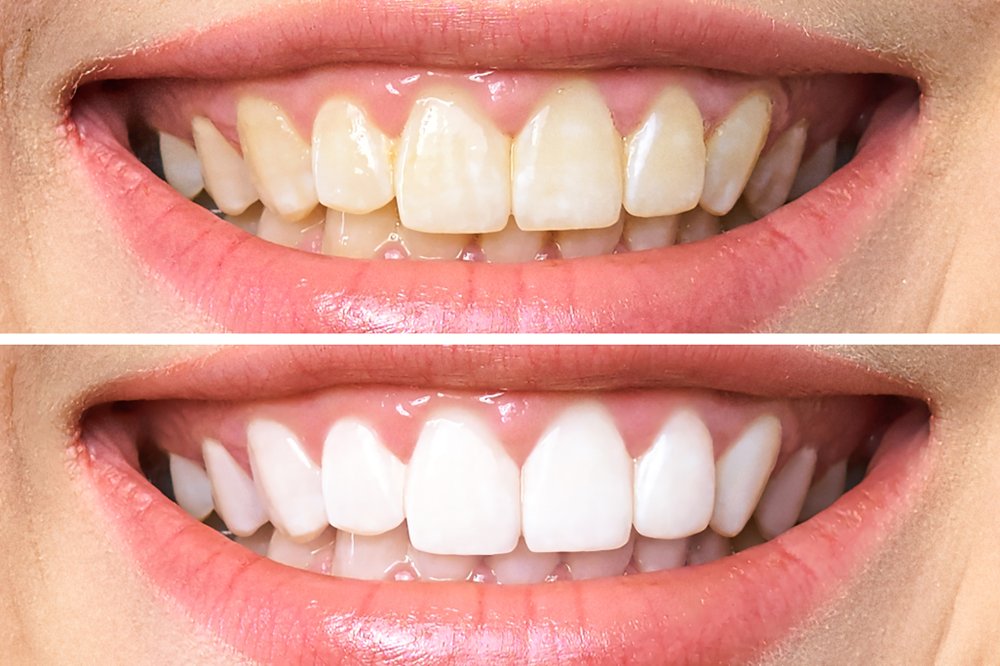 Are There Any Age Restrictions For Teeth Whitening?
