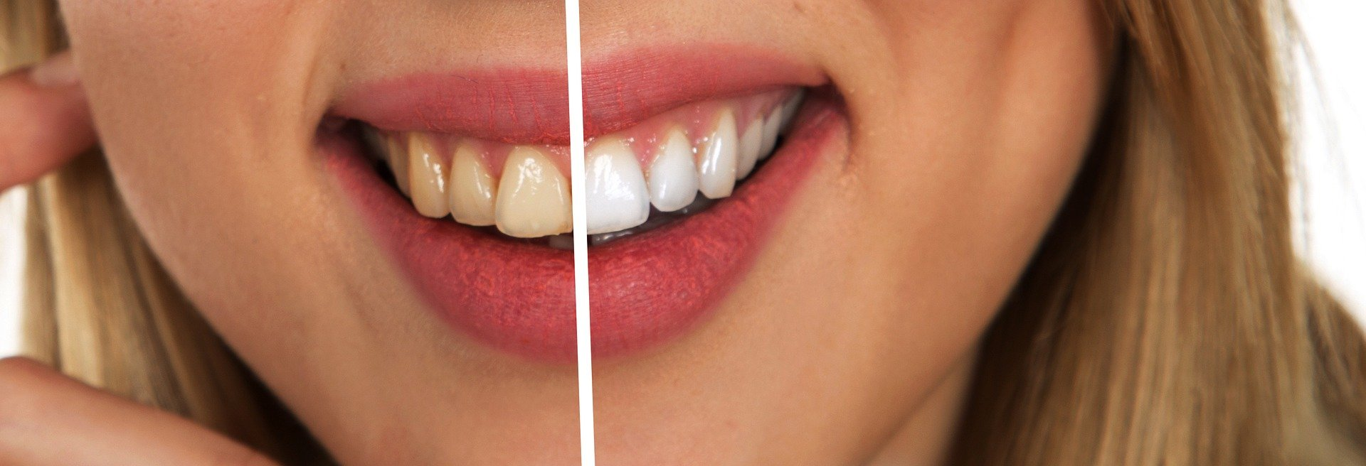 Are There Any Medical Conditions That Might Affect Teeth Whitening?