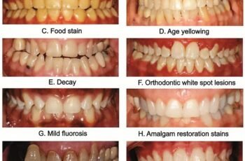 Are There Any Natural Ways To Whiten Teeth?