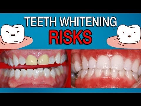 Are There Any Risks Associated With Teeth Whitening?