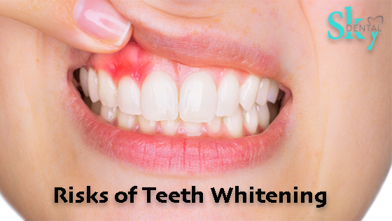 Are There Any Risks Associated With Teeth Whitening?