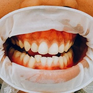 Can I Get My Teeth Whitened If I Have Gum Disease?