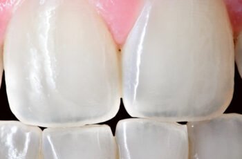 Can I Get Teeth Whitening If I Have Thin Enamel?
