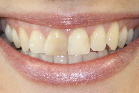 Can I Whiten Just One Tooth Thats Discolored?