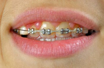 Can I Whiten My Teeth If I Have Braces?