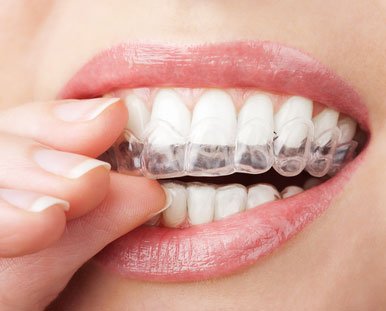 Can I Whiten My Teeth If I Have Cavities?