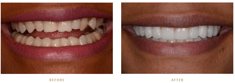 Can I Whiten My Teeth If I Have Dental Veneers?
