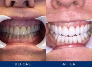 Can I Whiten My Teeth If I Have Dental Veneers?