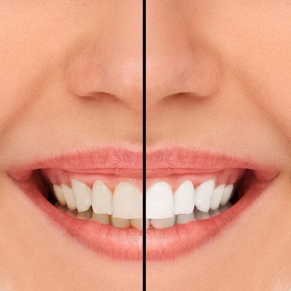Can I Whiten My Teeth If I Have Dental Veneers?