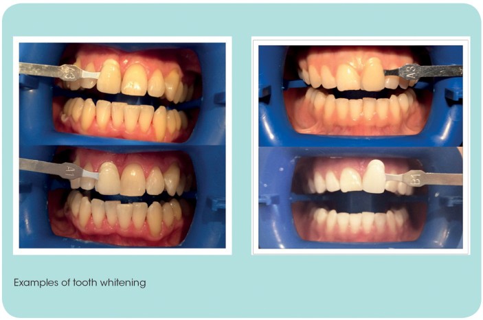 Can Teeth Whitening Remove All Types Of Stains?