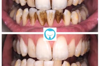 Can Teeth Whitening Remove All Types Of Stains?