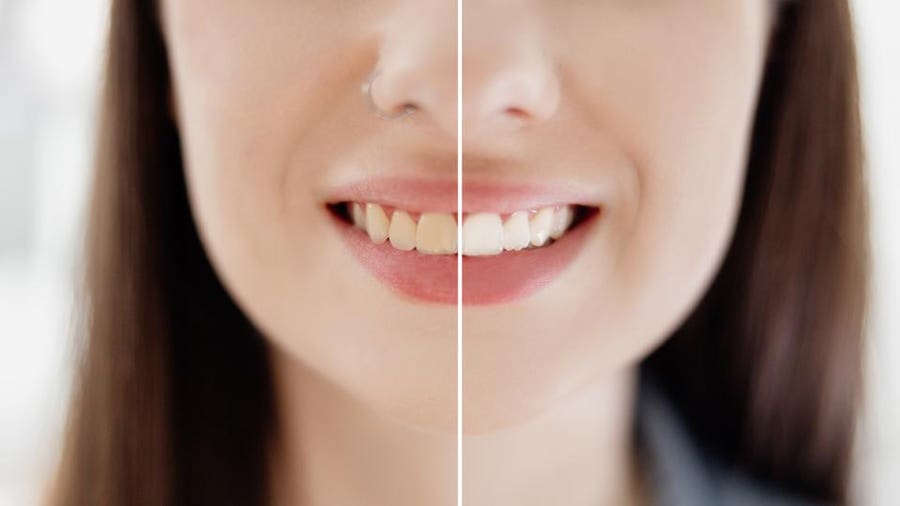 Does Insurance Cover The Cost Of Teeth Whitening?
