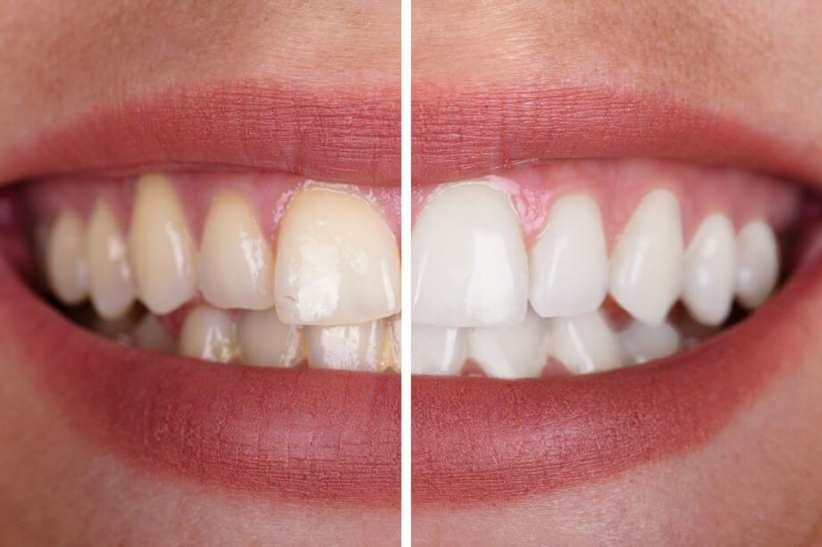 Does Insurance Cover The Cost Of Teeth Whitening?
