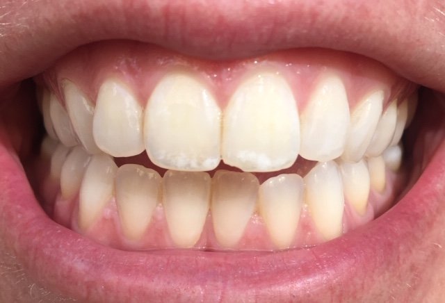 Does Teeth Whitening Reduce The Appearance Of White Spots On Teeth?