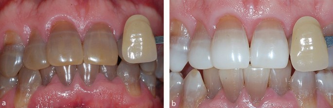 Does Teeth Whitening Work On Tetracycline-stained Teeth?