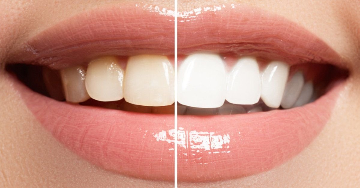 How Can I Maintain My White Teeth After Treatment?