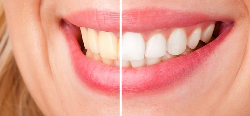 How Can I Maintain My White Teeth After Treatment?