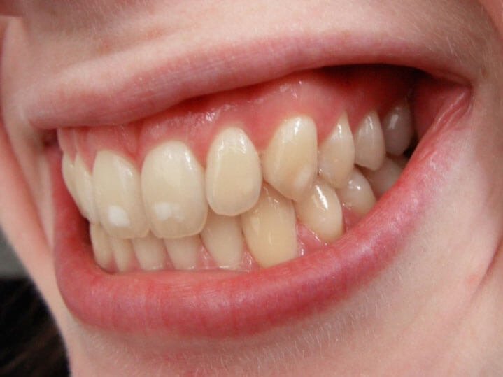 How Does Diet Influence Teeth Discoloration?