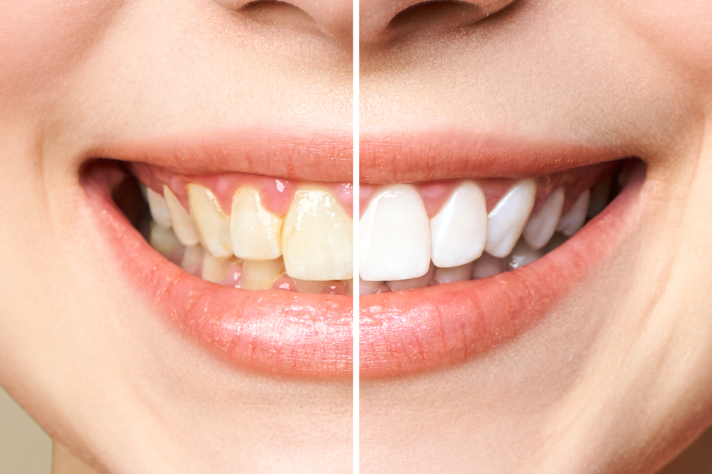 How Does Enamel Affect Teeth Sensitivity During Whitening?