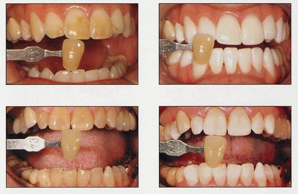 How Long Does Laser Teeth Whitening Take?