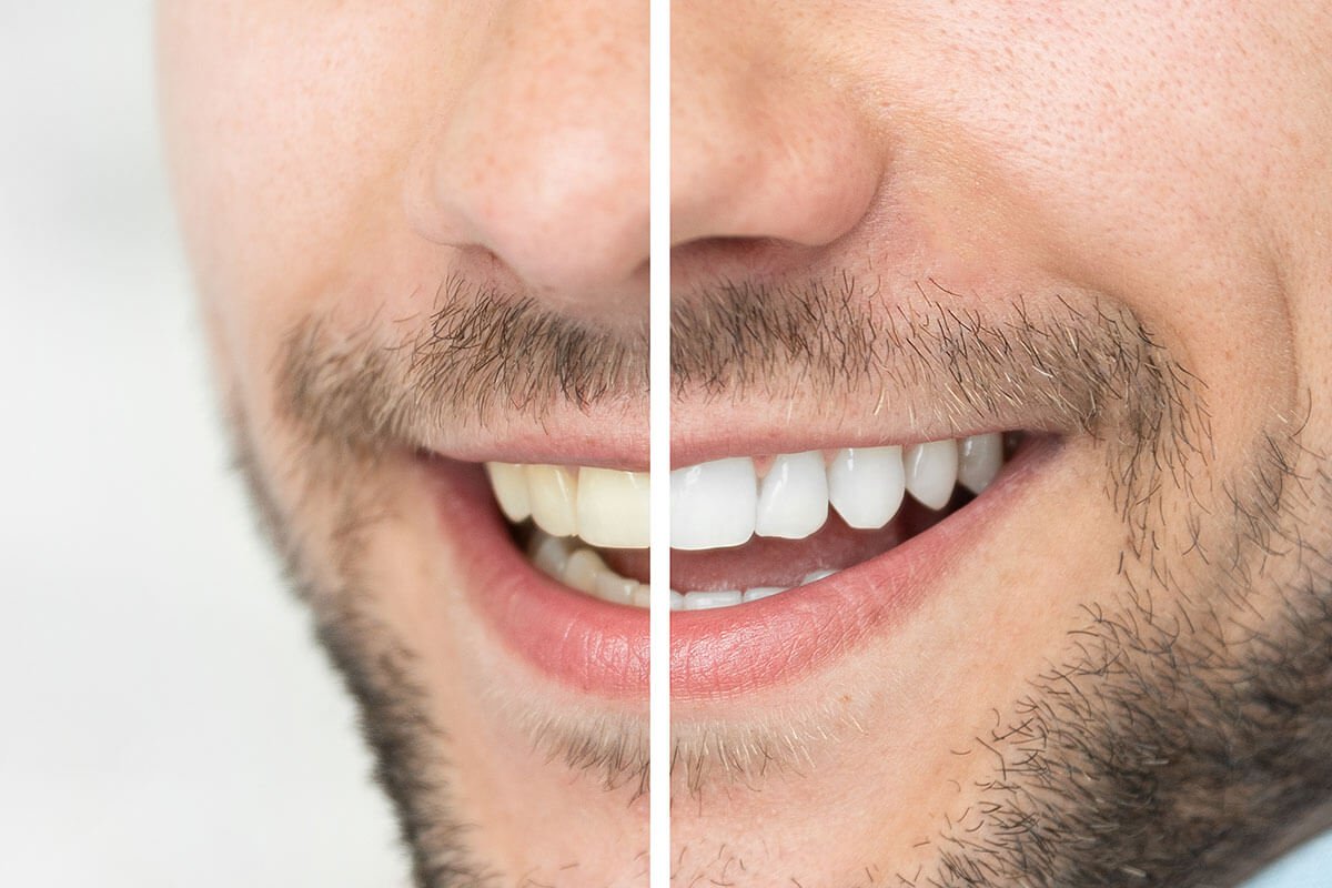 How Much Does Professional Teeth Whitening Cost?