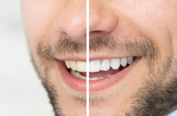 How Much Does Professional Teeth Whitening Cost?