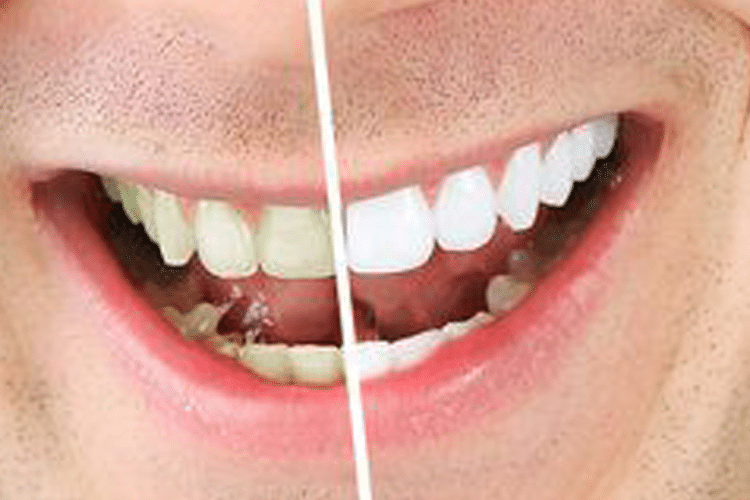 How Much Does Professional Teeth Whitening Cost?