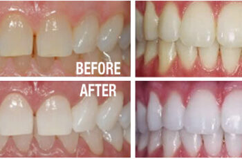 Is Teeth Whitening A Permanent Solution?