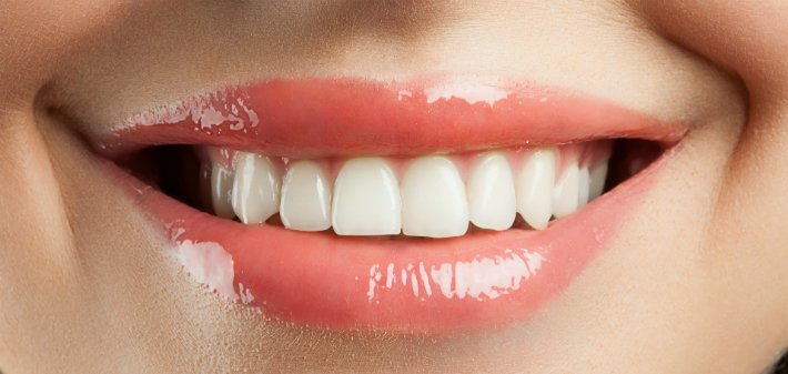 Is Teeth Whitening Effective On Crowns And Fillings?