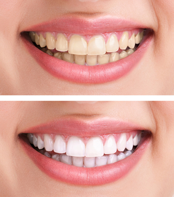 Is Teeth Whitening Effective On Crowns And Fillings?