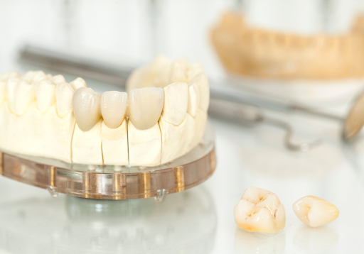Is Teeth Whitening Effective On Crowns And Fillings?