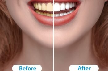 Non-Sensitive Teeth Whitener Kit Review