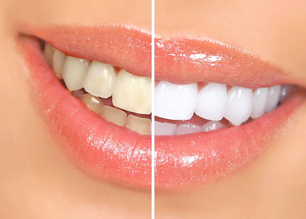 What Are The Common Methods Of Teeth Whitening?