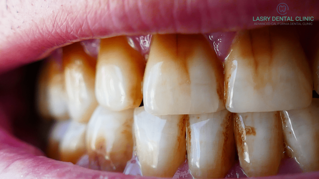 What Causes Teeth Discoloration?