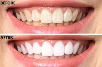 What Is Laser Teeth Whitening?