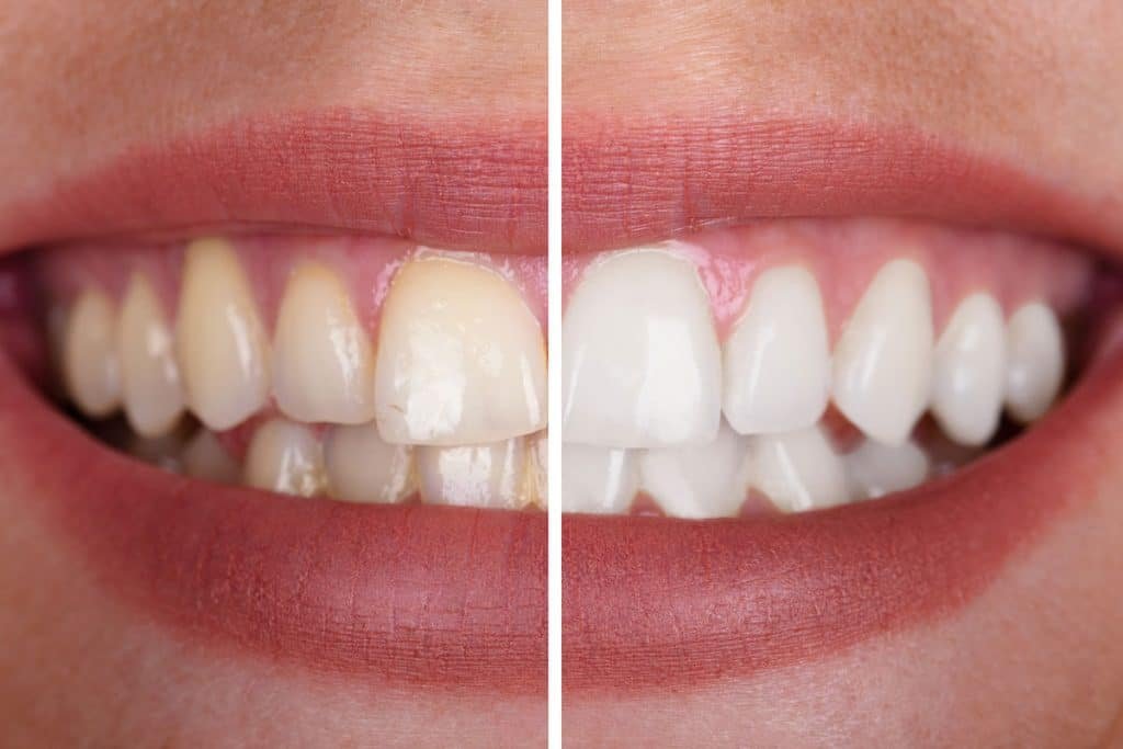 Whats The Difference Between In-office And At-home Whitening?