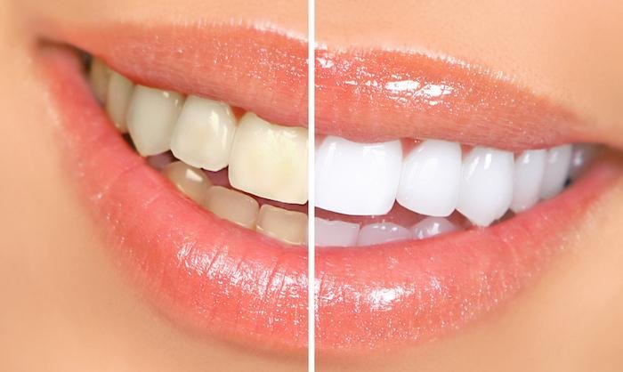 Whats The Difference Between In-office And At-home Whitening?