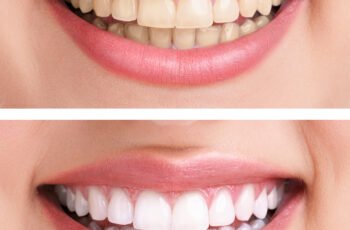 What’s The Role Of Hydrogen Peroxide In Teeth Whitening?